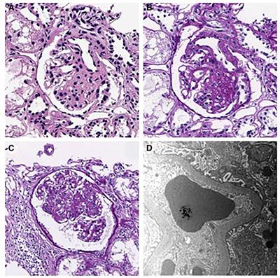 Case report: Focal segmental glomerulosclerosis in a pediatric atypical progeroid syndrome